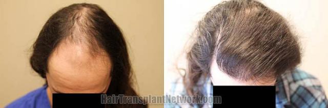 Top view - Before and after hair restoration procedure