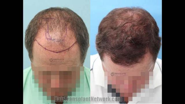 Hair transplantation surgery before and after images