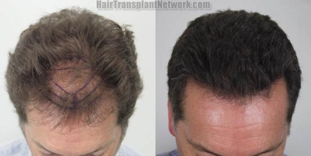 Hair restoration procedure before and after results