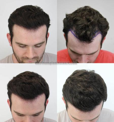 Before and after hair restoration procedure images