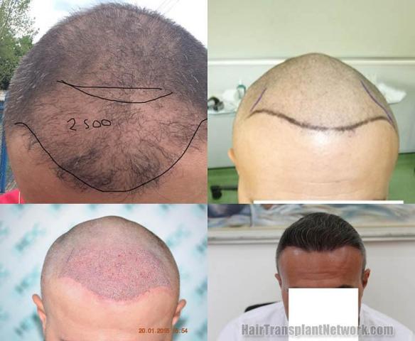 Hair transplantation surgery before and after images