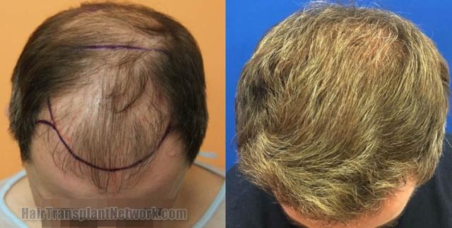 Hair transplantation surgery before and after images