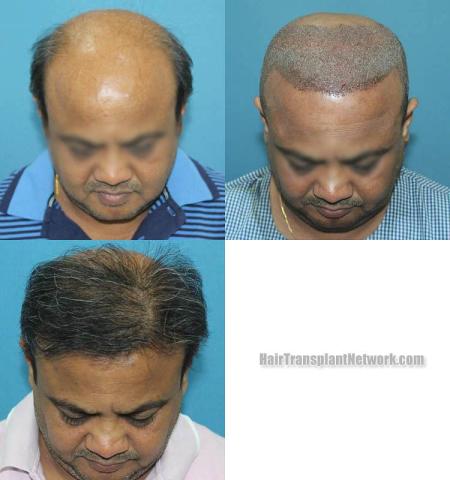 Before and after hair restoration procedure images