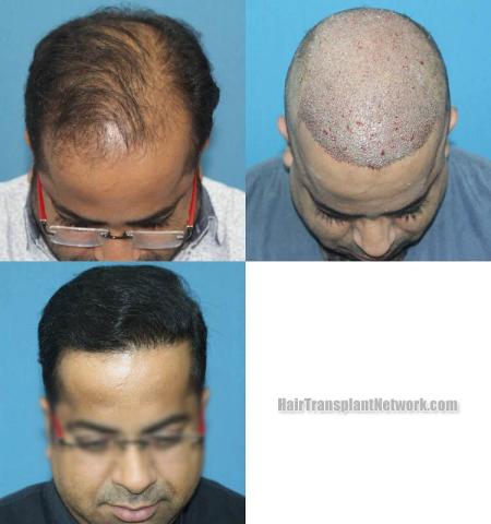 Before and after hair restoration procedure images