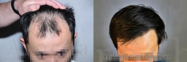 Before and after hair restoration procedure images