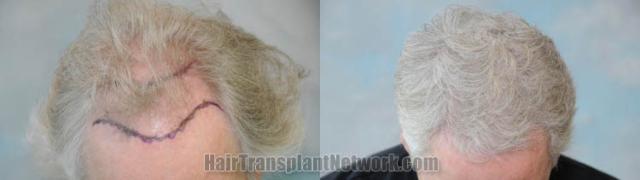 Hair transplantation surgery before and after images