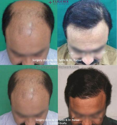 Hair transplantation surgery before and after images