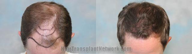 Before and after hair restoration procedure images