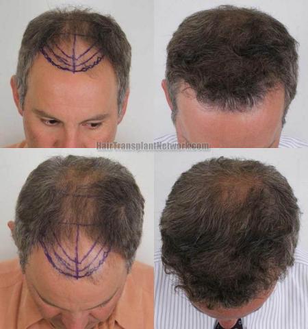 Hair transplantation surgery before and after photos