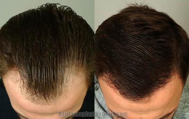 Hair transplantation surgery before and after images