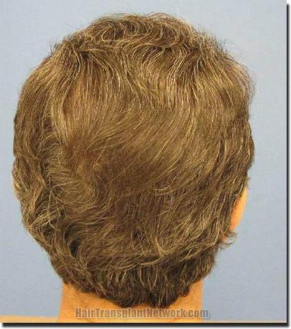 Hair restoration procedure results