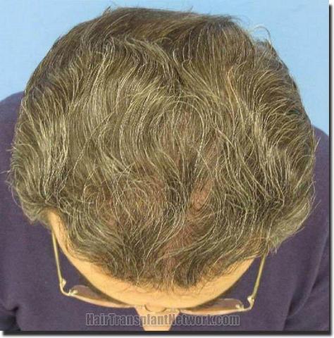 Hair restoration procedure results