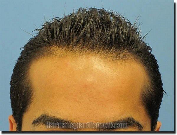 Hair restoration procedure results