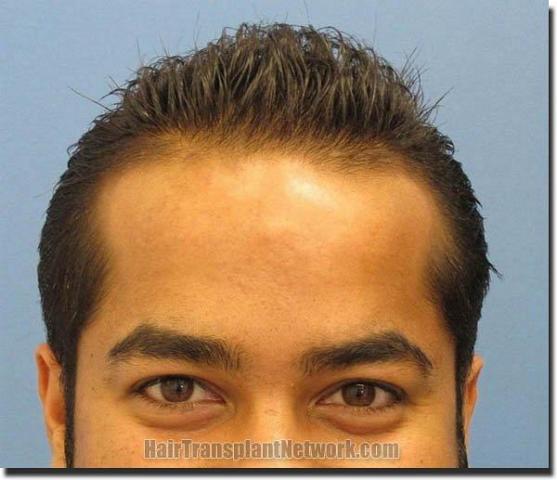 Hair restoration procedure results