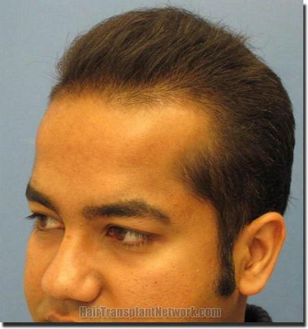 Hair restoration procedure results