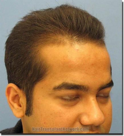 Hair restoration procedure results