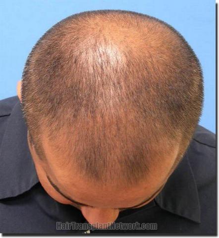 Hair restoration procedure results