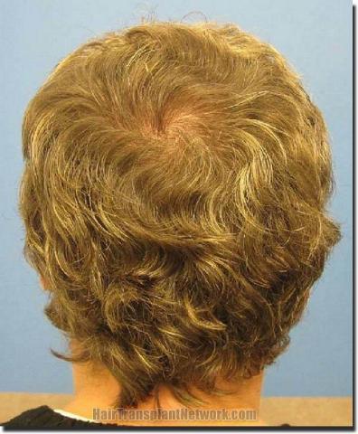 Hair restoration procedure results