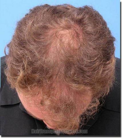 Hair restoration procedure results