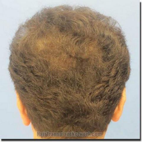 Hair restoration procedure results