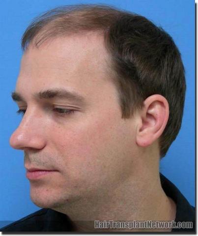 Hair restoration procedure results