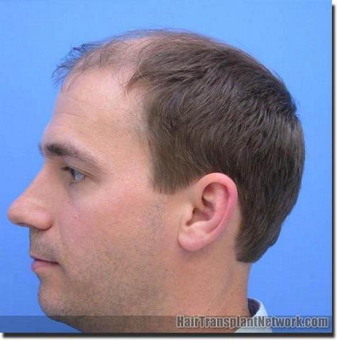 Hair restoration procedure results