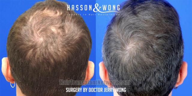 Surgical hair transplantation result photographs