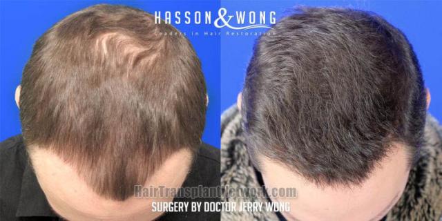 Hair transplantation surgery before and after images