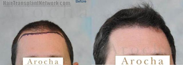 Hair restoration procedure before and after results