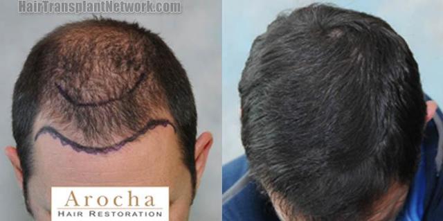 Hair transplantation surgery before and after photos