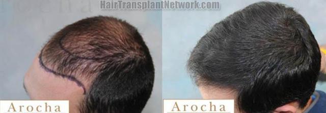 Hair transplantation surgery before and after images