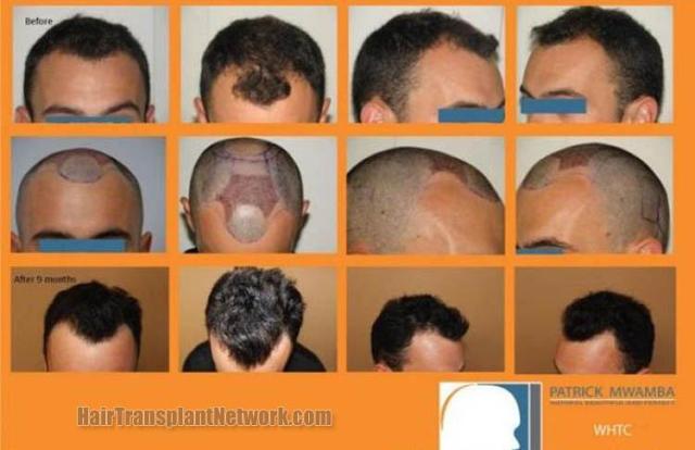 Before and after hair transplant procedure images