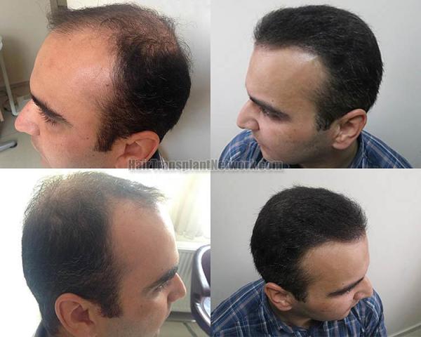 Hair restoration procedure before and after pictures