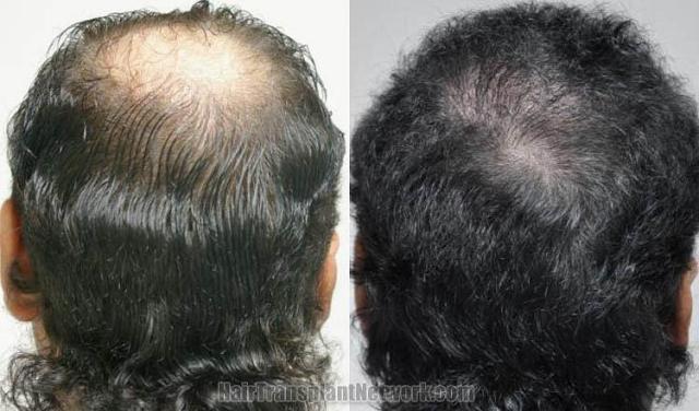 Back view before and after hair transplantation photos