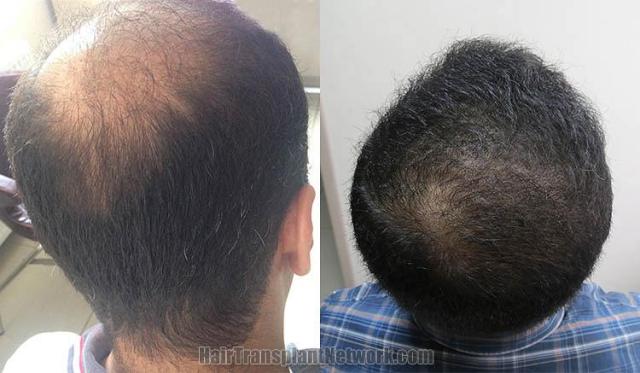 Hair transplantation surgery before and after pictures