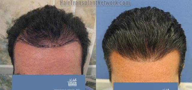 Hair restoration procedure before and after results