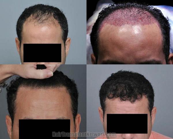 Hair transplantation surgery before and after pictures