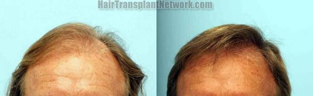 Hair transplantation surgery before and after photos