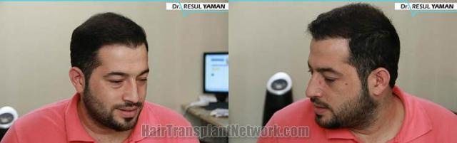 Hair transplantation surgery before and after photos