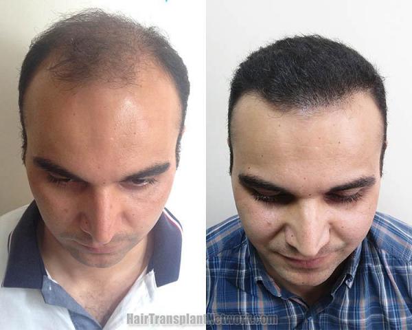 Hair restoration procedure before and after results