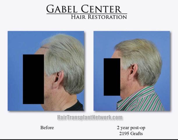 Hair restoration procedure before and after results