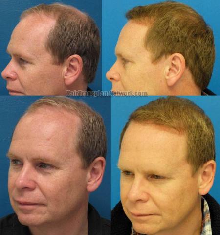 Hair transplantation surgery before and after pictures