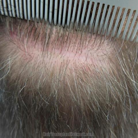 Hair transplant surgery before and after images