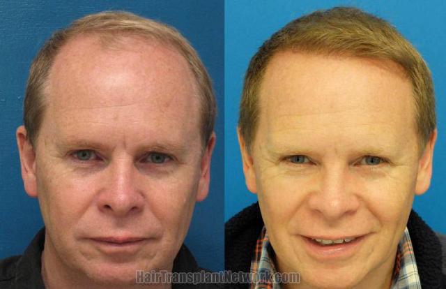 Hair restoration procedure before and after results