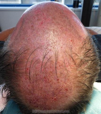 Hair transplant surgery before and after photos