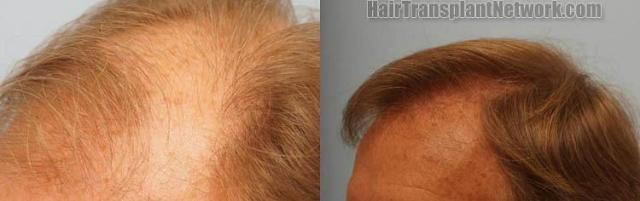 Hair restoration procedure before and after pictures