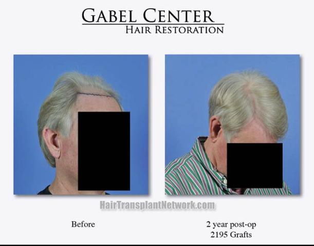 Hair transplant surgery before and after photos