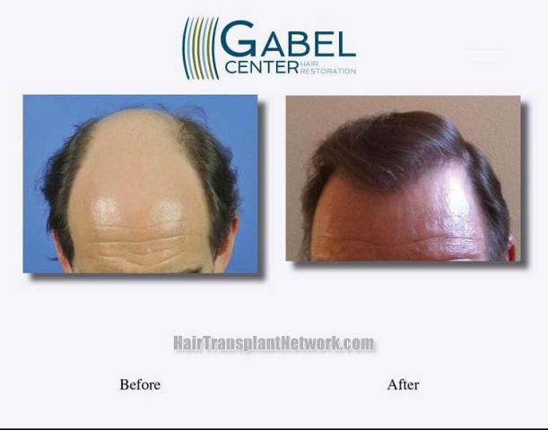 Before and after hair transplant procedure images