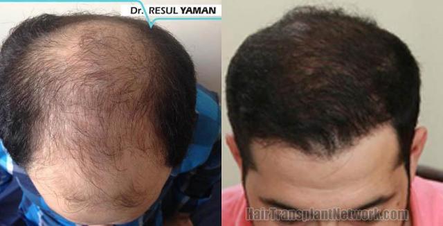 Top view before and after hair restoration results