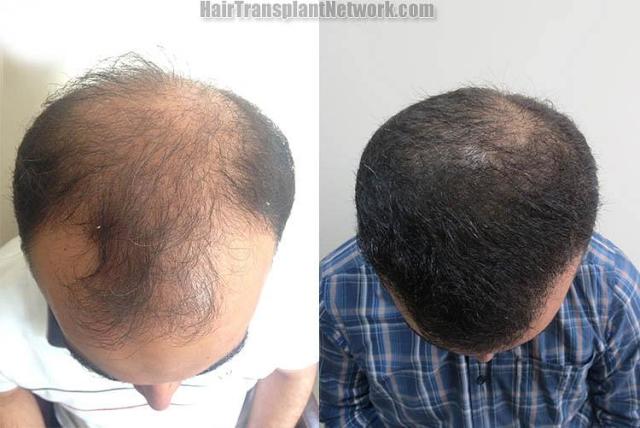 Hair transplantation surgery before and after photos